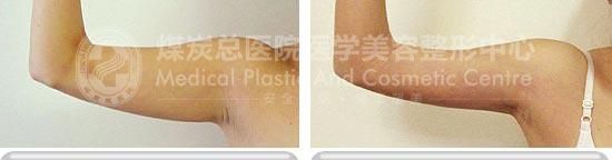 水动力吸脂消除手臂多余脂肪，纤纤玉臂惹人爱