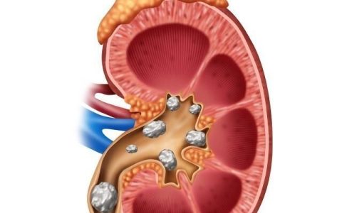 肾结石患者不能吃什么(肾结石不能吃什么食物)