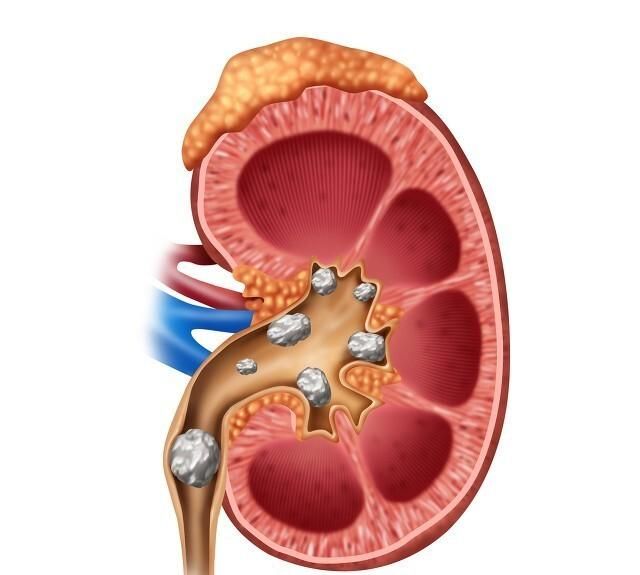 肾结石患者不能吃什么(肾结石不能吃什么食物)图1