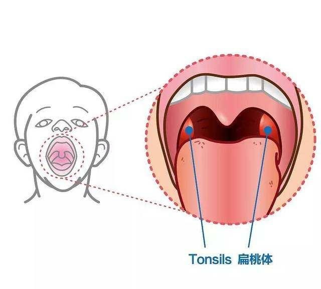 扁桃体发炎怎么办图1