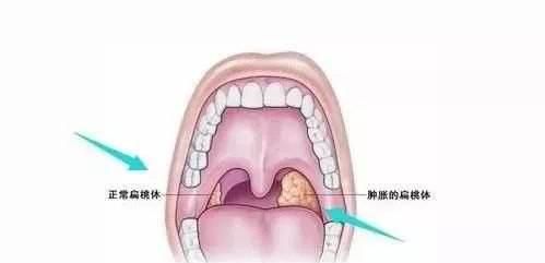 扁桃体发炎怎么办图2