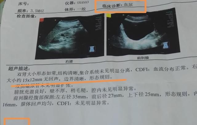 做增强ct,发现右肾小囊肿,会变成癌症吗图1