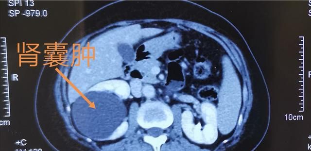 做增强ct,发现右肾小囊肿,会变成癌症吗图2