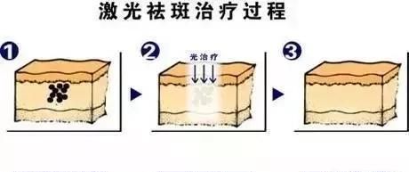 激光祛斑真的有效吗会反弹吗,激光祛斑真实有效吗图8