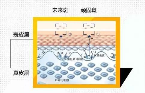 激光祛斑真的有效吗会反弹吗,激光祛斑真实有效吗图10