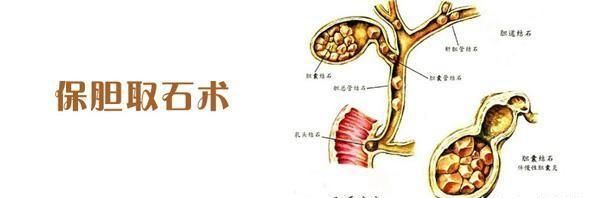有什么治疗胆囊结石的方法推荐图4