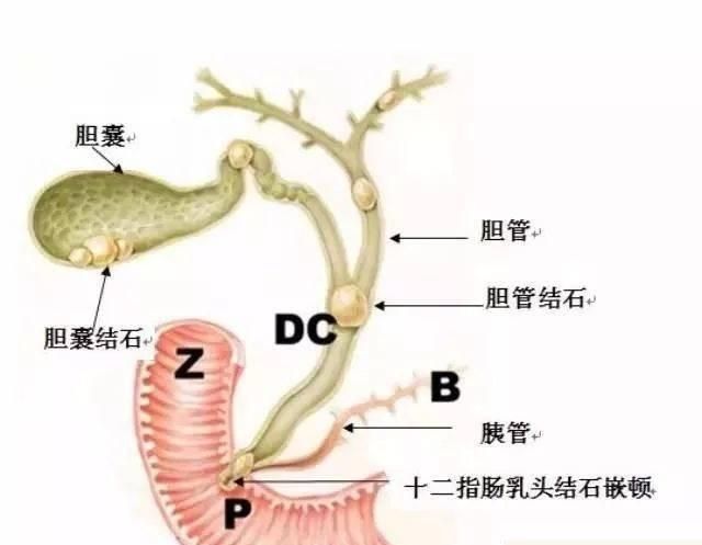 有什么治疗胆囊结石的方法推荐图9