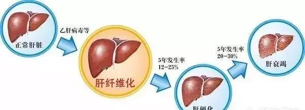 肝衰竭的原因有哪些图1