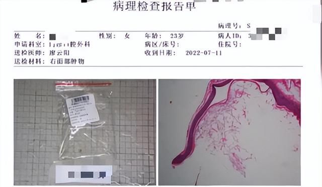 女子用粉刺针挑痘痘致脸部感染手术缝6针：表皮样囊肿，拖了1年，缝了2层