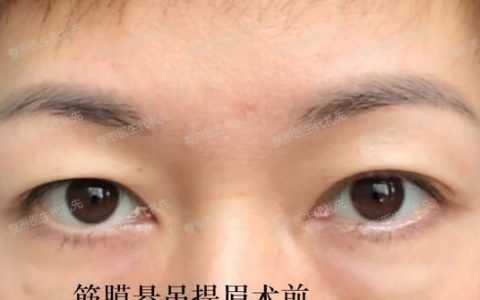 眼周拉皮能保持多久(眼周拉皮手术多少钱)
