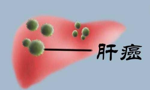 肝癌会传染吗,肝癌会传染吗可以一起吃饭生活吗图1