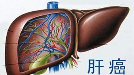 肝癌会传染吗,肝癌会传染吗可以一起吃饭生活吗图3