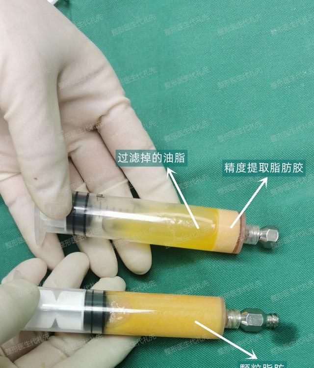 眼窝凹陷用什么填充最好？该选玻尿酸还是脂肪？脂肪能长期存活吗