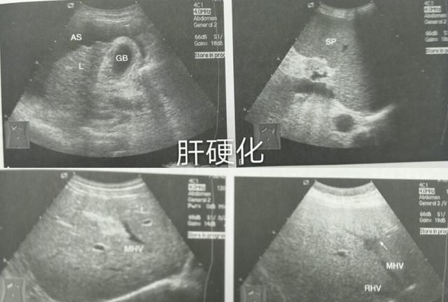 肝实质回声不均匀是怎么回事,肝实质回声欠均匀多个无回声暗区图3