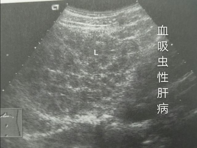 肝实质回声不均匀是怎么回事,肝实质回声欠均匀多个无回声暗区图4