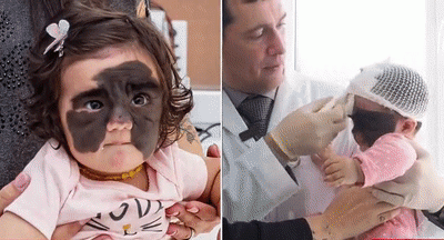 女婴面部黑色胎记像蝙蝠侠面罩 神奇手术让母亲惊喜：来俄罗斯对了