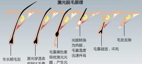 冰点脱毛是什么体验,冰点脱毛是什么意思图2