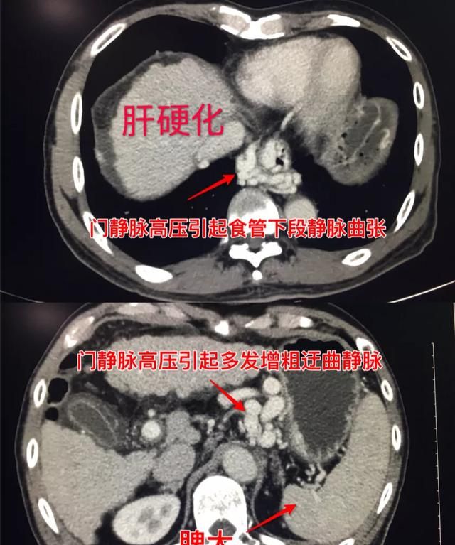 肝硬化能活多久(结节肝硬化活多久)图2