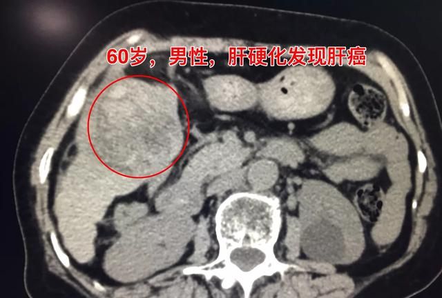 肝硬化能活多久(结节肝硬化活多久)图4