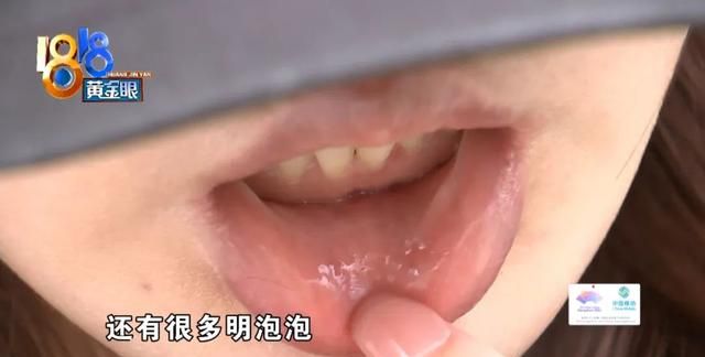 唇部注射玻尿酸 打完很多“明泡泡”
