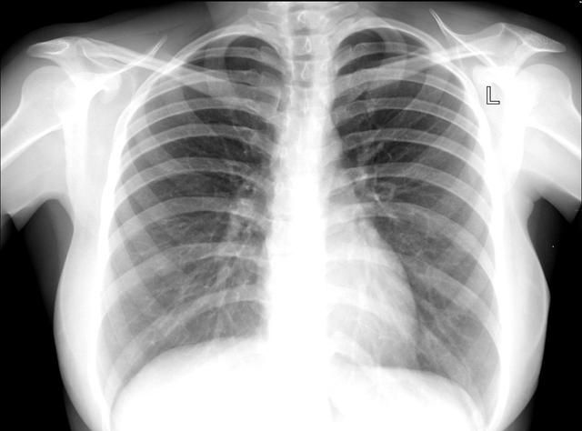 两肺纹理增粗是什么意思(两肺纹理增粗是什么意思咳嗽有痰)图1