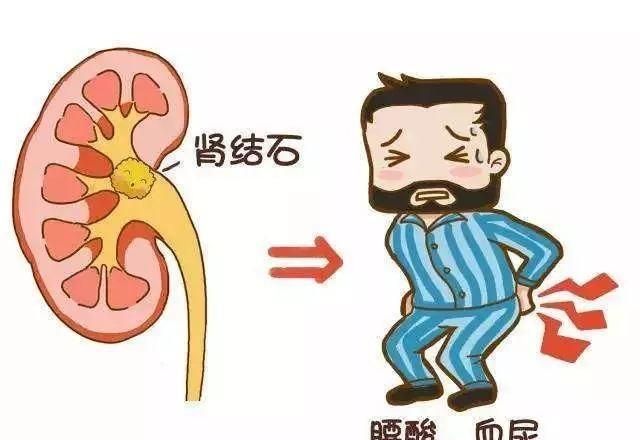 肾结石碎石几天可以恢复,肾结石体外冲击波碎石后多久恢复图1