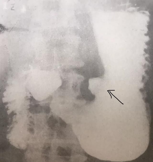 胃溃疡如何诊断,胃溃疡如何诊断出来图4