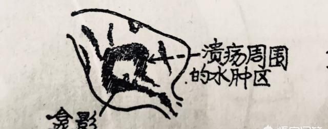 胃溃疡如何诊断,胃溃疡如何诊断出来图8