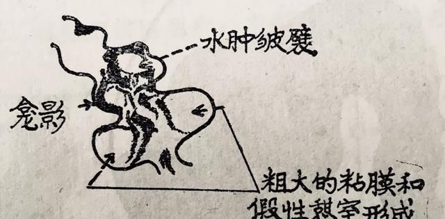 胃溃疡如何诊断,胃溃疡如何诊断出来图9