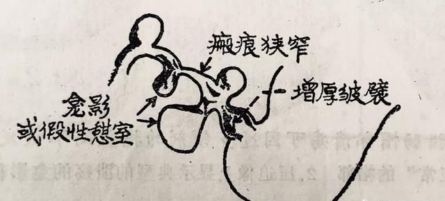 胃溃疡如何诊断,胃溃疡如何诊断出来图10