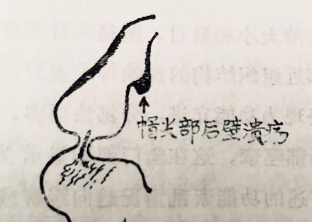 胃溃疡如何诊断,胃溃疡如何诊断出来图11