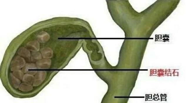 胆结石有什么症状,胆结石有什么症状能引起头晕吗图2