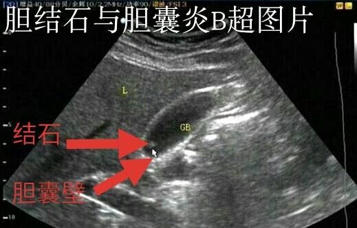胆结石有什么症状,胆结石有什么症状能引起头晕吗图3