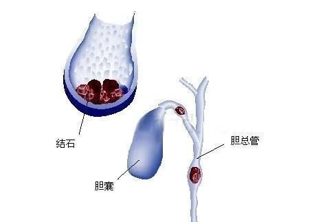 胆结石有什么症状,胆结石有什么症状能引起头晕吗图4