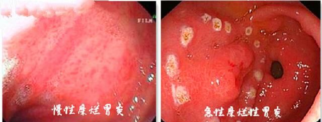胃炎的症状表现有哪些,胃炎的主要表现症状有哪些图5