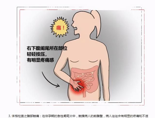 现在不手术也能治疗阑尾炎吗？对，ERAT了解一下，简单安全有效