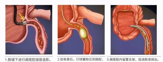 现在不手术也能治疗阑尾炎吗？对，ERAT了解一下，简单安全有效