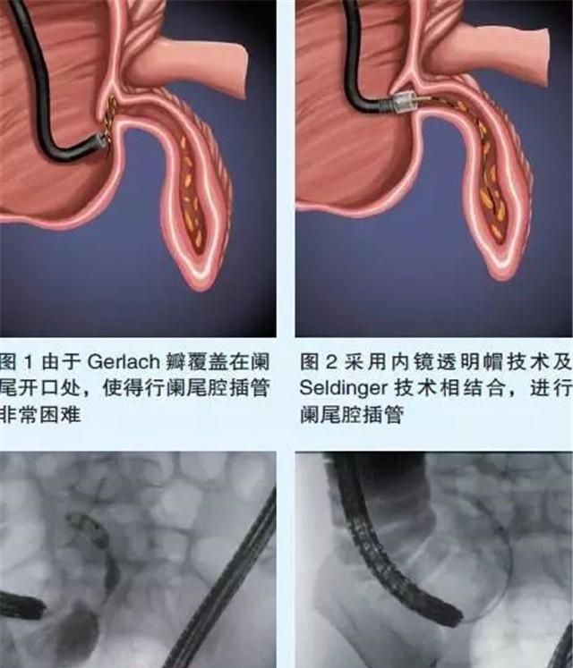 现在不手术也能治疗阑尾炎吗？对，ERAT了解一下，简单安全有效