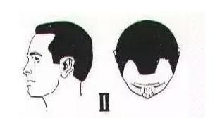 有什么简单的办法可以防止脱发(防止脱发和快速生发的方法)图15