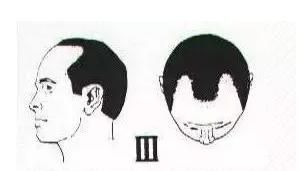 有什么简单的办法可以防止脱发(防止脱发和快速生发的方法)图16