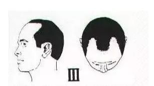 有什么简单的办法可以防止脱发(防止脱发和快速生发的方法)图16
