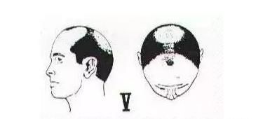 有什么简单的办法可以防止脱发(防止脱发和快速生发的方法)图18