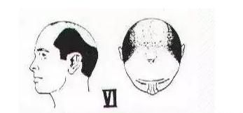 有什么简单的办法可以防止脱发(防止脱发和快速生发的方法)图19
