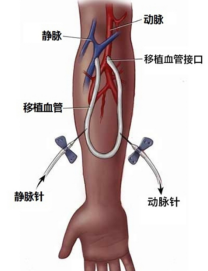 “人工血管”到底如何穿刺，你知道吗？