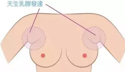 副乳手术痛苦吗图2