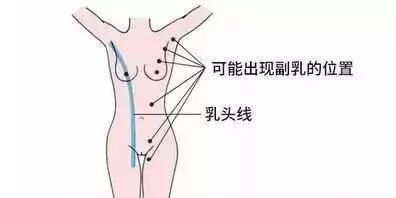 副乳手术痛苦吗图3