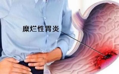 糜烂性胃炎应该如何治疗,糜烂性胃炎3级怎么治疗