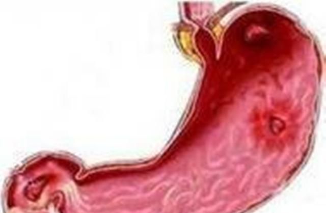 糜烂性胃炎应该如何治疗,糜烂性胃炎3级怎么治疗图2