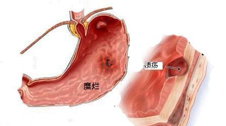 糜烂性胃炎可怕吗图4