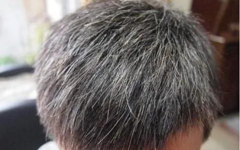 白发该如何治疗(淘米水治疗白发)